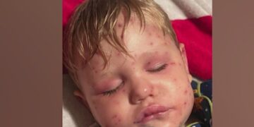 Georgia Toddler Stung 150+ Times by Yellowjackets: What to Know