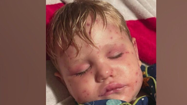 Georgia Toddler Stung 150+ Times by Yellowjackets: What to Know
